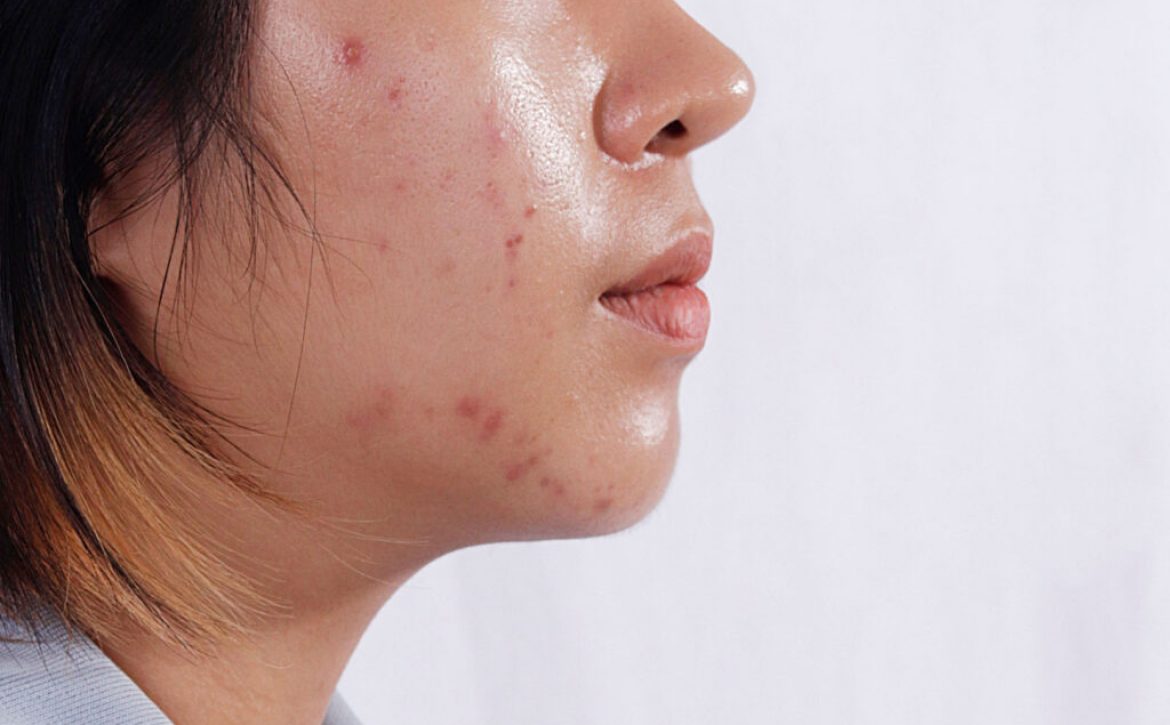 Close,Up,Acne,Skin,Caused,By,Hormone,oily,Face,In,Woman