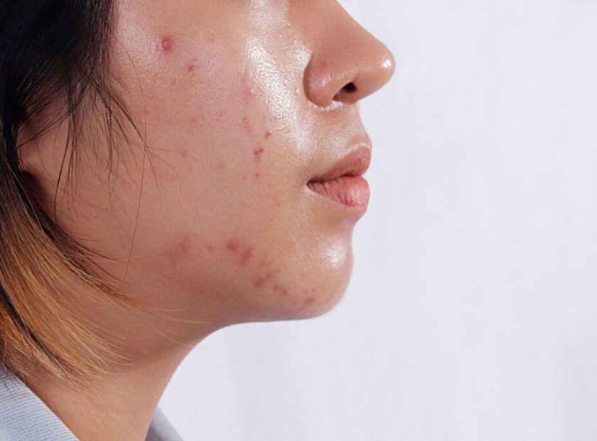 Close,Up,Acne,Skin,Caused,By,Hormone,oily,Face,In,Woman